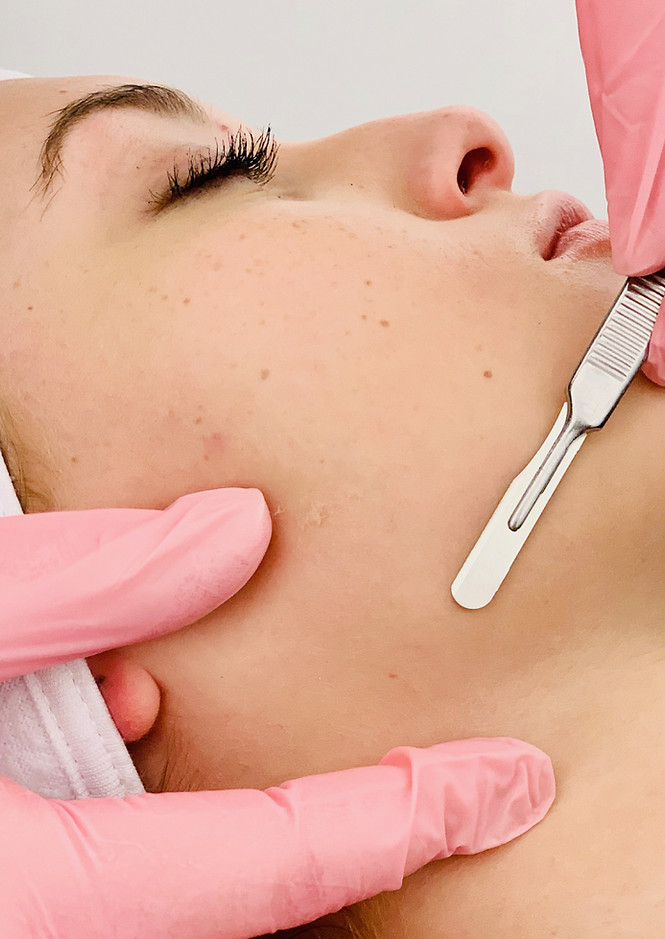 remove-peachfuzz-dermaplane-facial