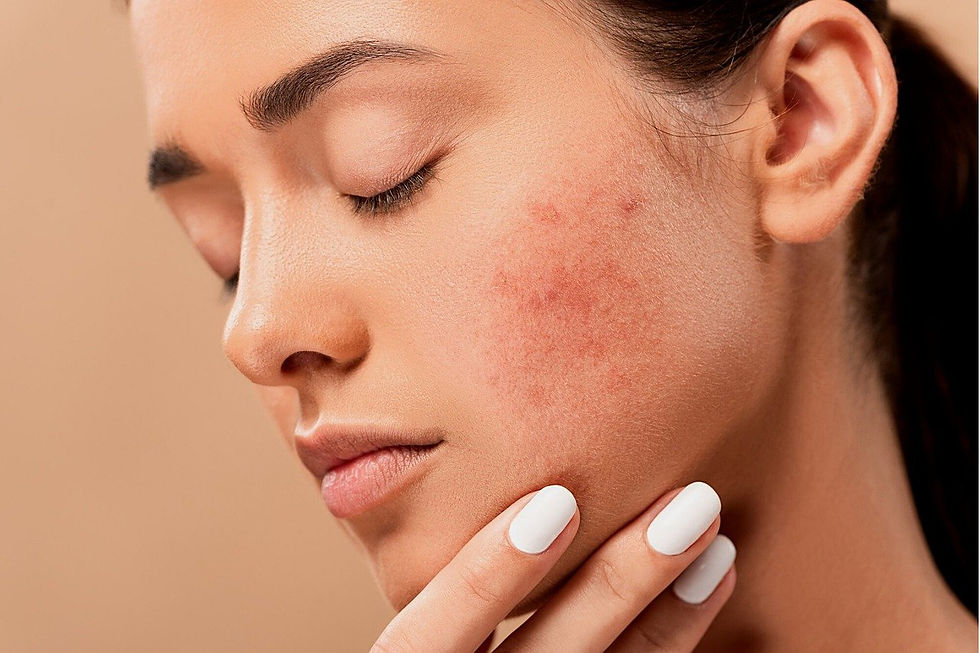 Acne Solutions