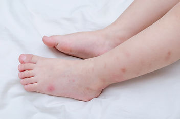 bed bugs treatment