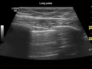 Gif animation af ultralydsscanning af lunge puls