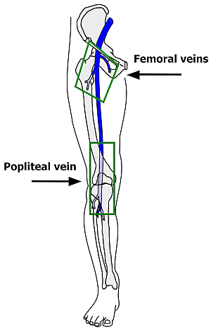 Anatomisk tegning af vena poplitea og vena femoralis med henblik på at vise kar, hvori der hyppigst opstår dyb venetrombose