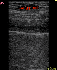 Gif animation af ultralydscanning af lungerne med påvisning af lung point ifbm pneumothorax