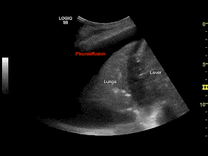 Gif animation af ultralydscanning af lungerne med påvisning af pleuraeffusion