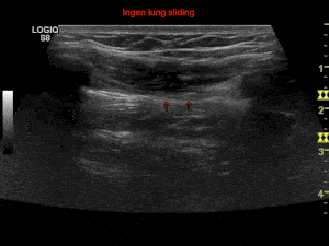 Gif animation af ultralydscanning af lungerne uden lung sliding