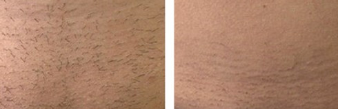 depilazione laser definitiva con il miglior laser al mondo dermatologo Dott. Emilio Betti