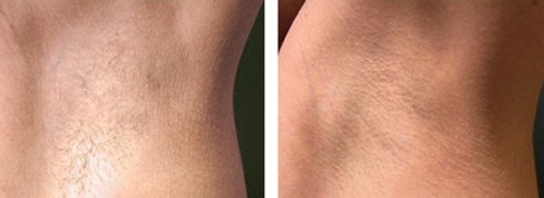depilazione laser definitiva con il miglior laser al mondo dermatologo Dott. Emilio Betti