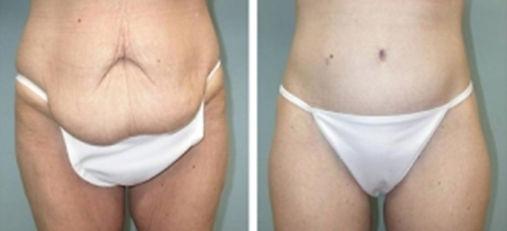 Addominoplastica . Prima Dopo