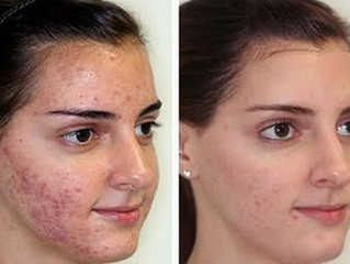 GUARIRE dall'ACNE oggi è possibile. !