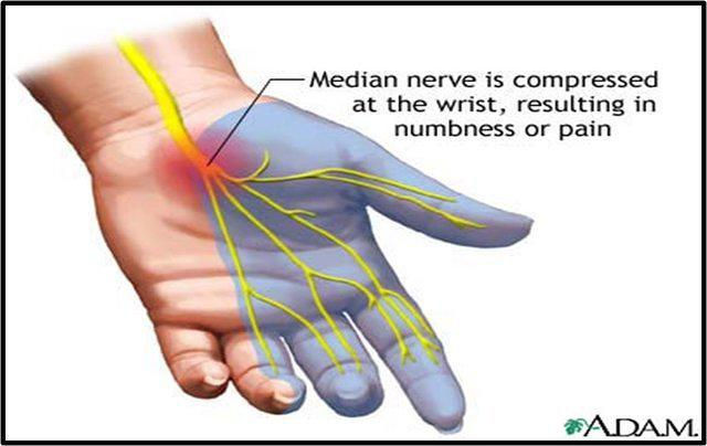 Is It Carpal Tunnel Tunnel Syndrome?