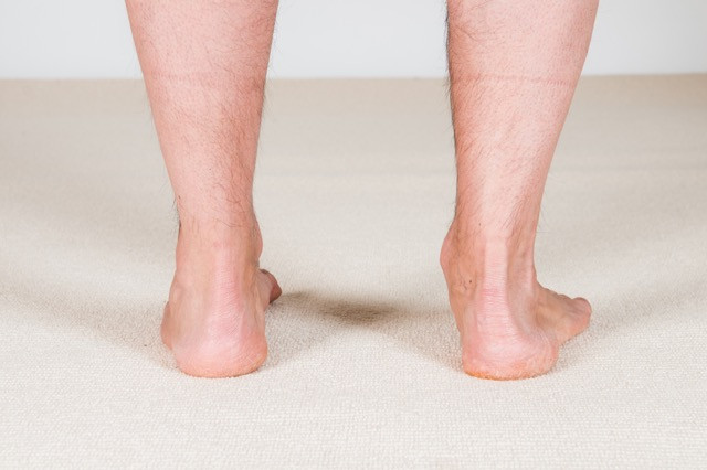 overpronation