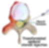 transformational epidural injection - pain management -revmedi
