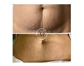 Loose skin fixed with Morpheus8