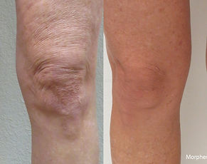 morpheus8-before and after knees_edited.