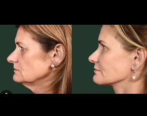 Before and after of loose neck treated with Morpheus8