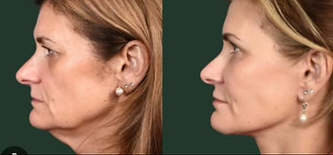 Treat sagging neck and jowels