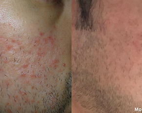 Morpheus8_Before&After acne_edited.jpg