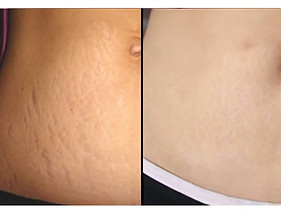 Treat stretch marks