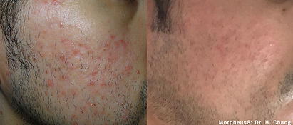 Treat Acne with Morpheus 8