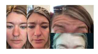 Before and after photos of Botox patients