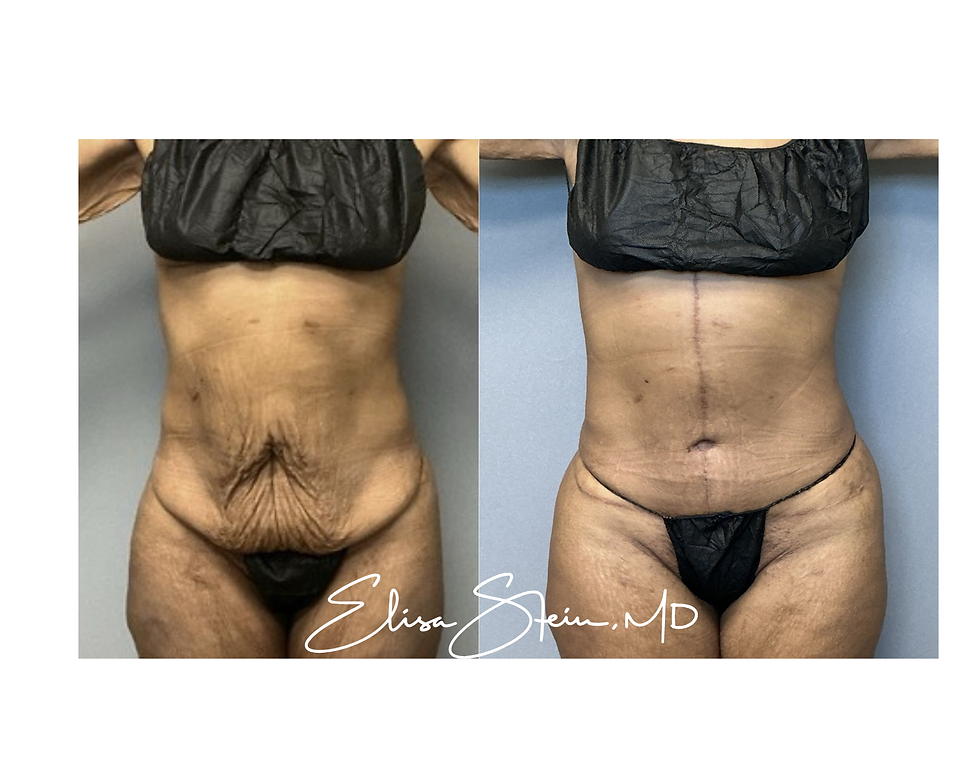 Before-and-after photos showing a woman’s abdomen following tummy tuck surgery, with removal of excess loose skin and improved abdominal contour.