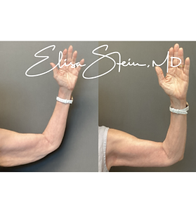 Before and after photos of arm lift (brachioplasty) patients