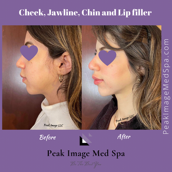 chin filler.PNG