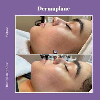 dermaplane.PNG