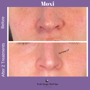 moxi before and after.PNG
