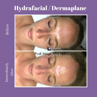 hydrafacial.PNG