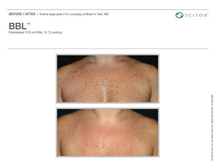 2chest  B&A Photos, BBL_(binder).png