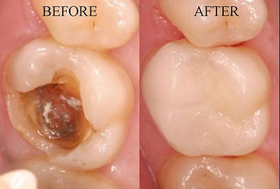 Bulk Bill Gap Free Cheap Dental White Filling Dentist Surfers Paradise Gold Coast