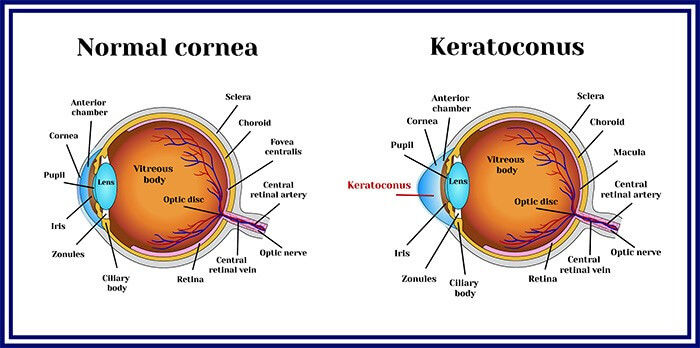 Kertoconus treatment by best cornea surgeon delhi