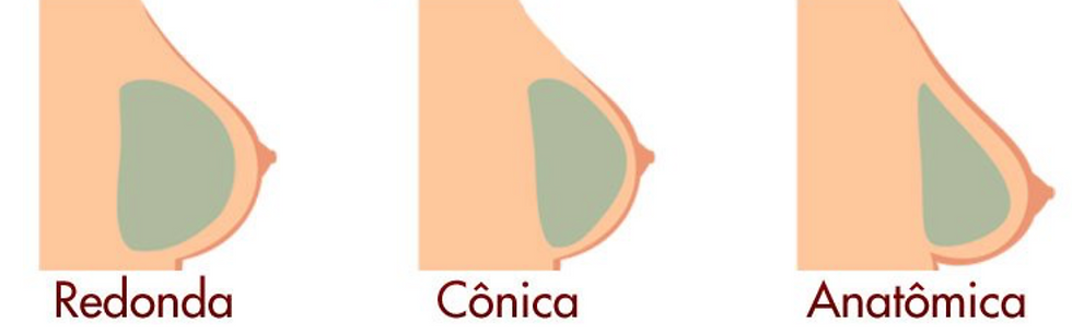 Silicone - Florianópolis - Mamoplastia de aumento - Dr. Leandro Grangeiro