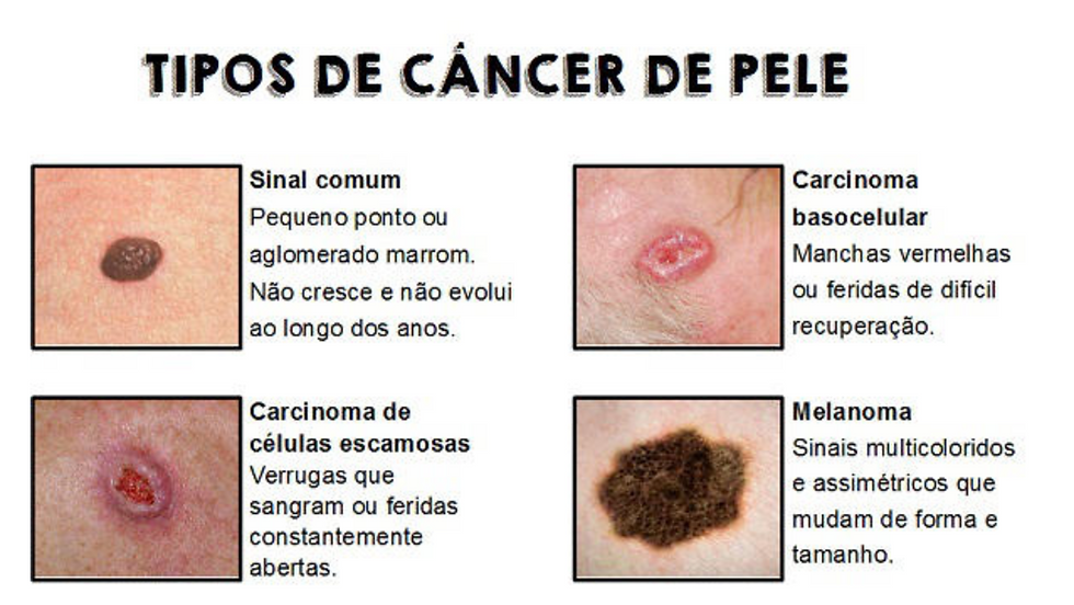 Cirurgia plástica para tratar o Câncer de Pele em Florianópolis com o cirurgião plástico Dr. Leandro Grangeiro
