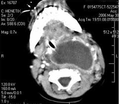 abscesso cervical