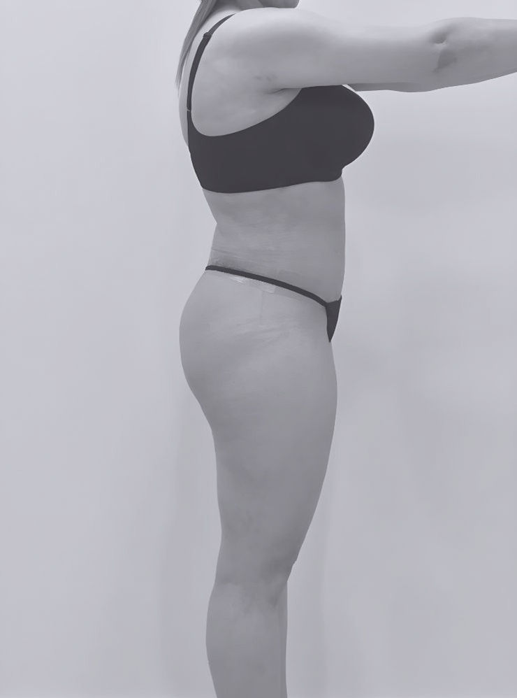 image of patient's side body after lipoabdominoplasty in fort mill