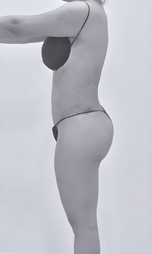 image of patient's side body after lipoabdominoplasty in fort mill