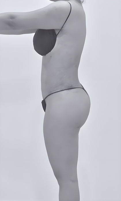 image of patient's side body after lipoabdominoplasty in fort mill