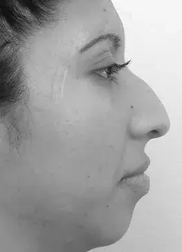 patient's nose before rhinoplasty in charlotte 