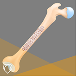Osteoporosis