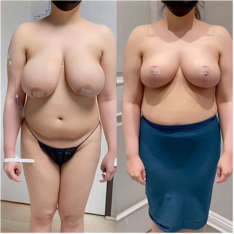 Before and after breast size reduction