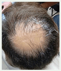 implantes de pelo antes y despues