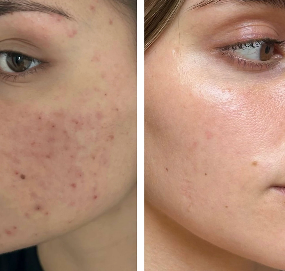 Thumbnail: Acne infusion 8 wekentraject