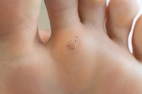 Foot verruca wart podiatrist horsforth_edited.jpg