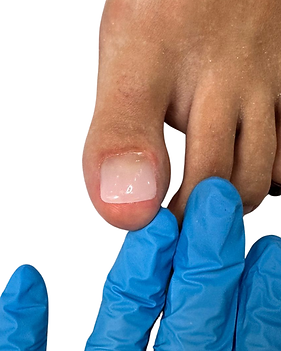 Toenail reconstruction podiatrist Horsforth