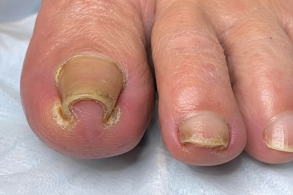 Ingrowing nail treatment Leeds