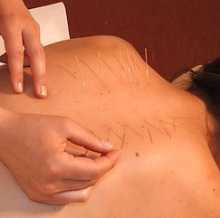 Akupunktur Nadeln Rücken