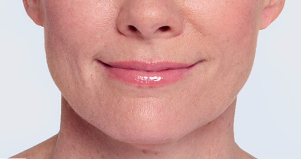AFTER Restylane® Lyft nasolabials