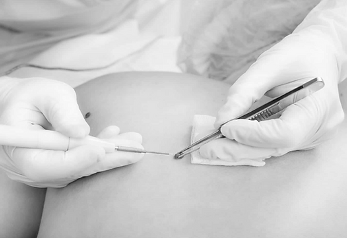 Skin lesion being removed from someones back
