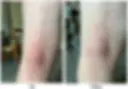 Resultado: Redução visível da inflamação e melhora clínica da coceira em 4 horas.